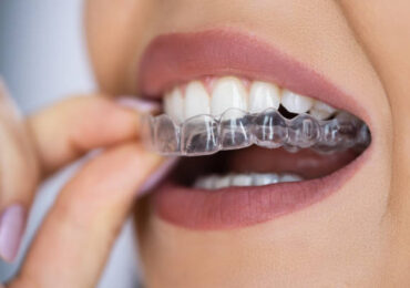 Invisalign